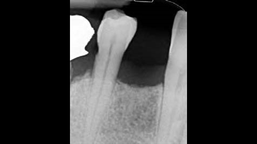 Fig. 2 Radiografia para operacionit