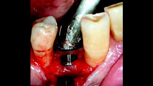 Fig. 3 Implanti i vendosur në nivelin e kreshtës