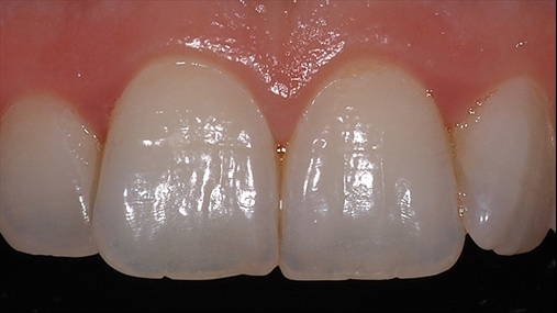 Fig. 1: shembull i incizivëve qendror me smalt translucent: smalti lejon që të shikohet përtej aty ku është i hollë, kontrasti i zi palatal (zona incizale) dhe chroma dentinale (zona cervikale)
