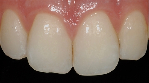 Fig. 2: shembull i incizivëve me smalt opaleshent: smalti nuk lejon që të duket kontrasti i zi palatal gjithashtu dhe në nivel incizal chroma e dentinës jo transparente