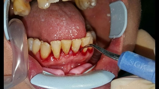 Fig. 3 Trajtimi i debridment periodontal është kryer me instrumente mekanike magnetostriktive me inlay FSI 1000-30k, këshilluar për heqjen e njollave dhe të mbetjeve të mëdha të tartarit rezistent.