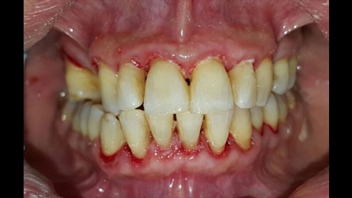 Fig. 7  Kjo është situata në fund të trajtimit. Pacientja ka marrë informacione rreth higjienës orale: është rekomanduar përdorimi i furçës elektrike me një kokë rrethore për të bërë më të lehtë pastrimin në zonat më të vështira dhe më pak të aksesueshme