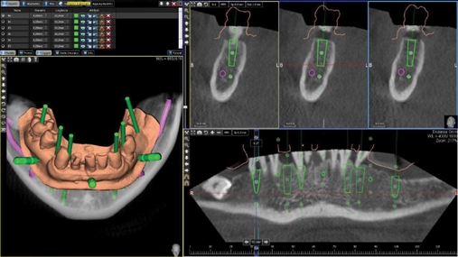 Projektimi kirurgjikal, software 3Diagnosys