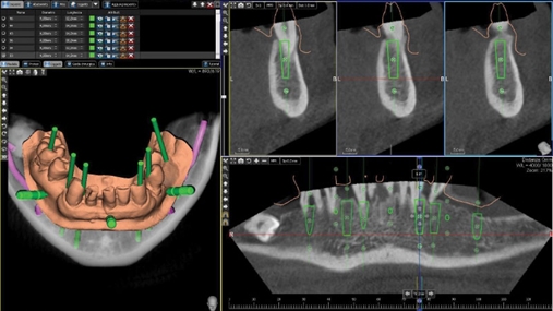 Projektimi kirurgjikal, software 3Diagnosys