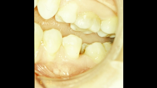 Fig. 5 Rasti 2: Situata fillestare: mungesa e molarit të parë në nofullën e poshtme