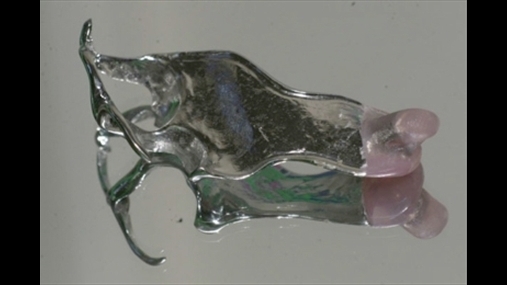 Fig. 2: Mbushja në formën e një proteze në krom – kobalt 