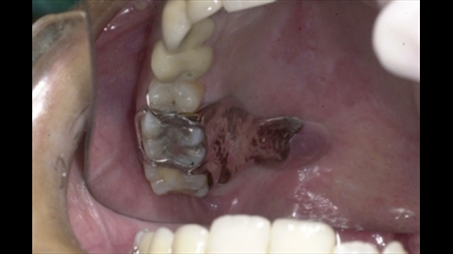 Fig.3: Pamja intra-orale e protezës së vendosur 