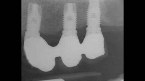 Radiografia e tre implanteve të ngjitur