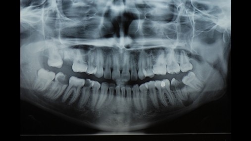 Figura 1: Ortopantomografia që tregon një lezion të përhapur osteolitik apikal të 37