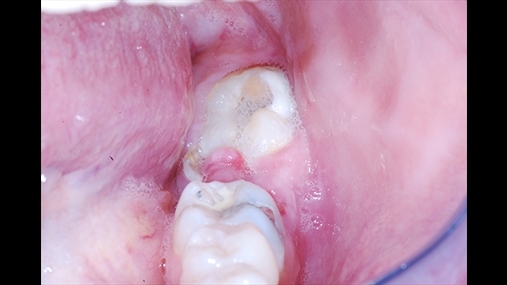 Figura 2: Ekzaminimi intraoral që tregon se zgavra e gojës nuk gëzon shëndet të mirë