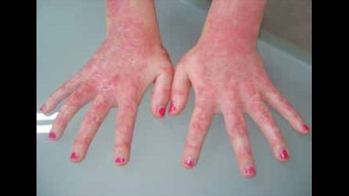 Fig 2: shfaqje të epidermolizës flluskoze simplex në duar dhe te gishtat