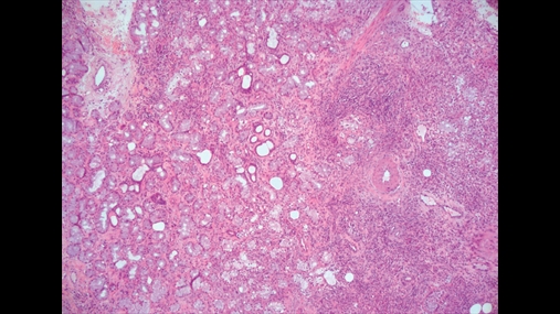Figura 2 Aspektet histologjie të kampionit të biopsisë së vënë në dukje një kuadër të sialadenitis kronik me regres atrofik, që lidhet me një infiltrim të rëndësishëm inflamtor (hematoksilina e eosinës, zmadhim 4X)