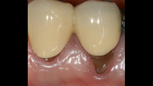 Figura 1: Detajet intraorale të elementit 34 dhe 35. Janë të pranishme restaurime protetike të papërshtatshme, vërehen tërheqje gingivale në ngarkim të elementëve dentar dhe në veçanti linja e përfundimit të 35