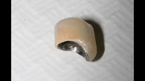 Figura 5: Pas shërimit është realizuar një kurorë me profil këndor, që merr parasysh jo vetëm zonën e kufijve të kurorës por edhe të formës së re të gingivave