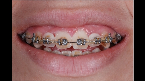 Situata në fund të trajtimit ortodontik