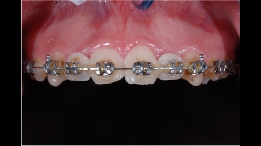 Situata në fund të trajtimit ortodontik
