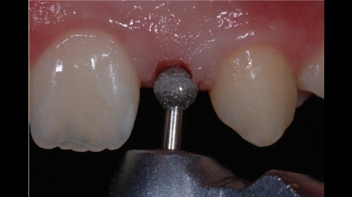 Kufizimi i zonave pa dhëmbë