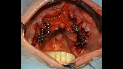 Fig. 02: Implantet të pozicionuar
