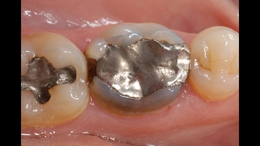 Fig. 5 Element dentar me restaurim të vjetër në amalgamë për tu zëvendësuar: ekziston