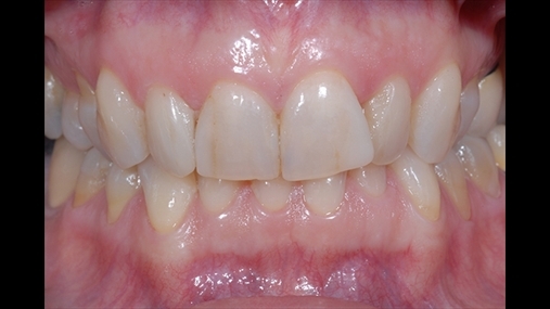 Fig. 8 Elemente dentare të sektorit anterior që paraqesin defekte në formë dhe në ngjyrë; situata ideale për përgatitjen e fasetave në material qeramike.