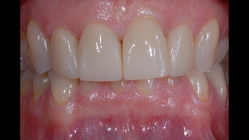 Fig. 11 Rezultati final që harmonizohet më së miri  me indet parodontale dhe me elementet dentare që janë pranë