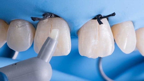 Ceram.x universal A1 është pozicionuar te dhëmbi i modeluar nëpërmjet spatulës së hollë. E gjithë procedura është kryer me dorë të lirë.