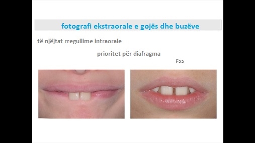 Fig. 18 Konfigurime për gojën dhe buzët