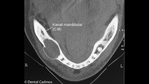 Fig. 1-a Radiografia preoperatore q evidenton lezionin radiotransparent mandibular