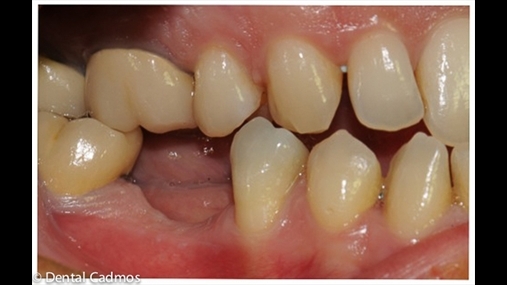 Fig. 7 Situata klinike pre-implant; pamja laterale