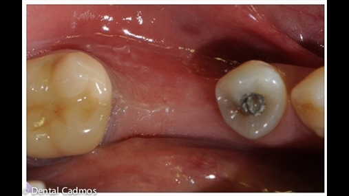 Fig. 8 Situata klinike pre-implant; pamja okluzale