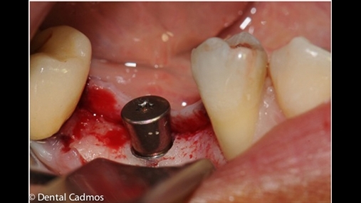 Fig. 10 Pamja intraoperatore e implantit t pozicionuar