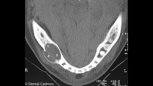 Fig. 1-b Skanimi tomografik evidenton zgjerimin e lezionit me zhvillimin t prhapur n ann vestibulare t mandibuls
