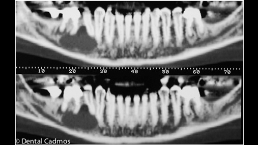 Fig. 1-c Skanimi i ngjashm me at panoramik evidenton kontaktin direkt midis nervit alveolar dhe lezionit