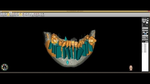 Software për programimin në 3D të ndërhyrjes së piezocision e drejtuar nga kompjuteri (Cortex, Media Lab, Milano, Itali); kortikotomitë projektojnë virtualisht duke respektuar plotësisht strukturat anatomike 