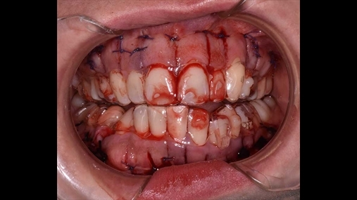 Menjëherë pasi është kryer kortikotomia me dorezën piezoelektrike (piezocision) dhe pasi janë kryer qepjet e mukozës është e mundur të fillohet me trajtimin ortodontik me maskerina transparente (Smiletech®, Ortodoncia Itali, Romë)