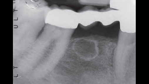 Fig. 1 Radiografia intraorale që shfaq një lezion radiolucent me kufij të pastër dhe të trashë