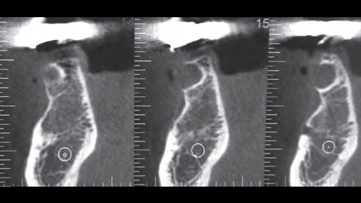 Fig. 2 Seksionet TC që tregojnë riabsorbimin e kortikales vestibulare në njësinë premolare, kuadranti IV
