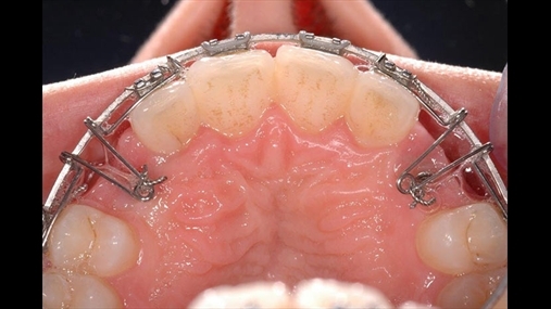Fig. 2: Dy susta Kilroy të aktivizuara nëpërmjet rrotullimit në elementin dentar që duhet ekspozuar dhe fiksimi me fill për lidhje. Vektori rezultant do të drejtohet poshtë dhe drejt pjesës së jashtme 