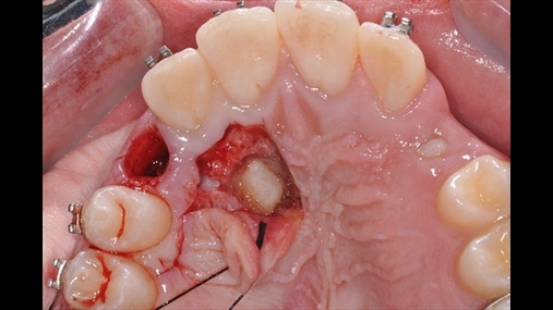 Fig. 5: Ekspozimi i kaninit. Qepja e lembos duke respektuar strukturat periodontale të dhëmbëve fqinj dhe hemostazës. Tuneli i përftuar nga heqja e dhëmbit të qumështit do të shfrytëzohet për tërheqjen e elementit të retinuar në pozicionin e tij natyral