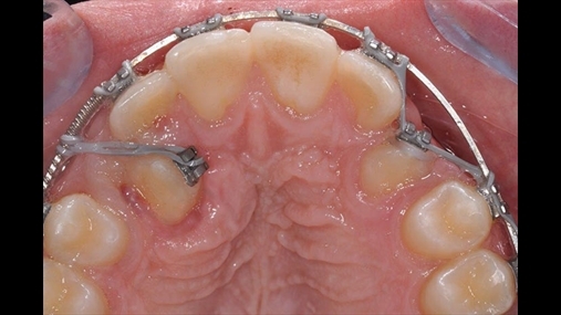 Fig. 7: Sapo porcioni i dhëmbit të ekspozuar e lejon, butonat zëvendësohen nga ngjitëse dhe tërheqja vazhdon nëpërmjet zinxhirëve elastik