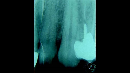 Fig. 2 Radiografia endorale nuk tregon shenja t prfshirjes s indeve t forta prreth lezionit