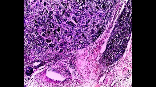 Fig.3: Fotomikrograf që shfaq kapsulën e lezionit të kufizuar ku nuk demonstrohen qeliza neoplastike (H&E me njolla, zmadhim origjinal: 20x)
