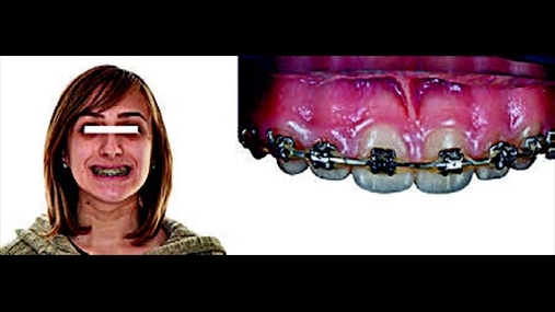 Fig.5: Pr t ndihmuar ortodontin n terapin e specializuar, kryhen restaurime provizore n kompozit n 1.2 dhe 2.2 pa teknika adezive, n mnyr q t mund t hiqen lehtsisht n fund t ortodoncis