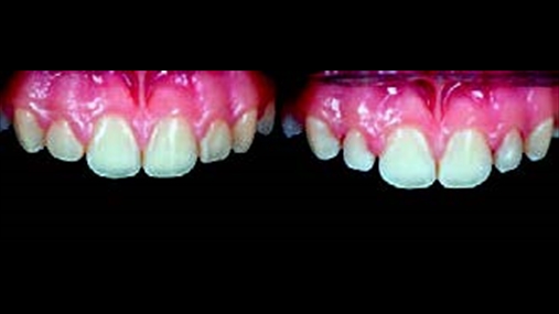 Fig.6: Detaje t ashtuquajturave restaurime provizore (n t majt) dhe pas heqjes s tyre n fund t trajtimit ortodontik (n t djatht)