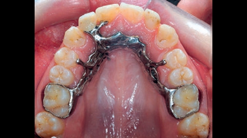 Fig. 6 Pamja okluzale e protezës provizore me perforim të molarëve të parë permanent.
