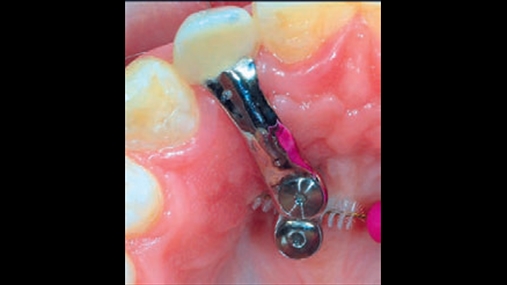 Fig. 9 Veçanti të strukturës metalike të vidhosur në zgavrën e gojës: paraqitet e dukshme se si manovrat e higjienës orale mund të kryen lehtësisht me përdorimin e furçës interdentare.