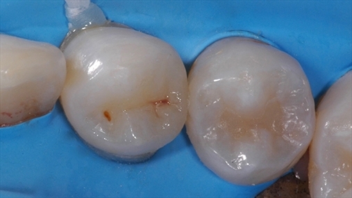 Fig. 6 Restaurimi i klasës II realizuar nëpërmjet aplikimit të teknikës “total etch” në smalt dhe dentinë sipas Fusayama 1992