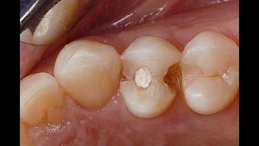 1. Rasti fillestar: dështimi endodontik bën të nevojshëm ekstraksionin e elementit 1.4, operacion i komplikuar duke qenë se pareti vestibular paraqitet i hollë