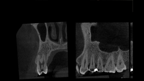1. Rasti fillestar: dështimi endodontik bën të nevojshëm ekstraksionin e elementit 1.4, operacion i komplikuar duke qenë se pareti vestibular paraqitet i hollë