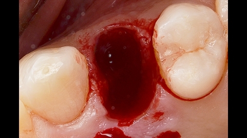 2. Ekstraksioni atraumatik i premolarit 1.4 duke mbajtur të pa prekur të gjithë paretet e alveolës 